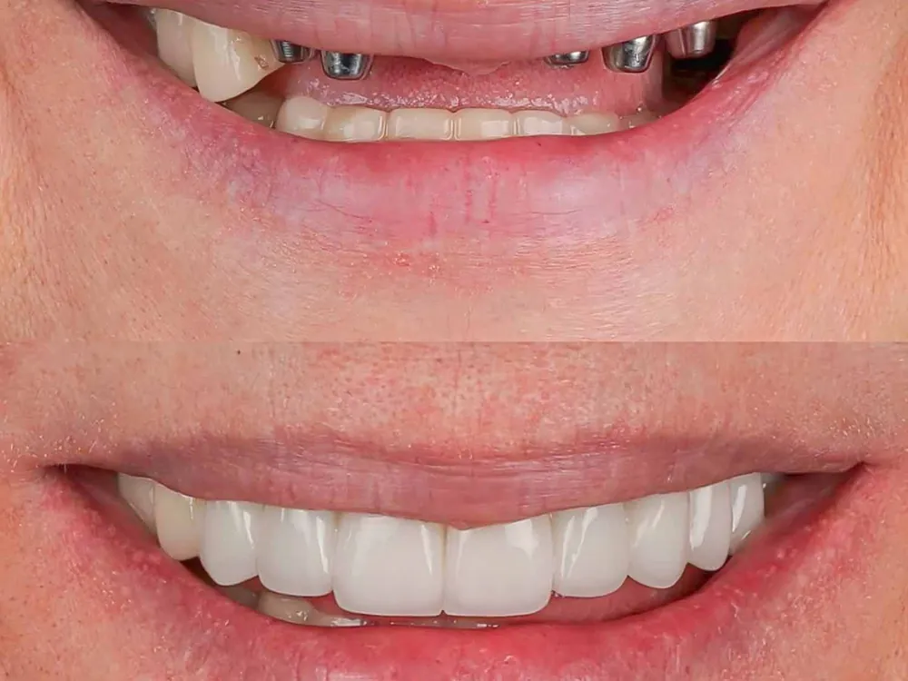 Възстановена усмивка със зъбни импланти — преди и след, Doc3Dental Търговище