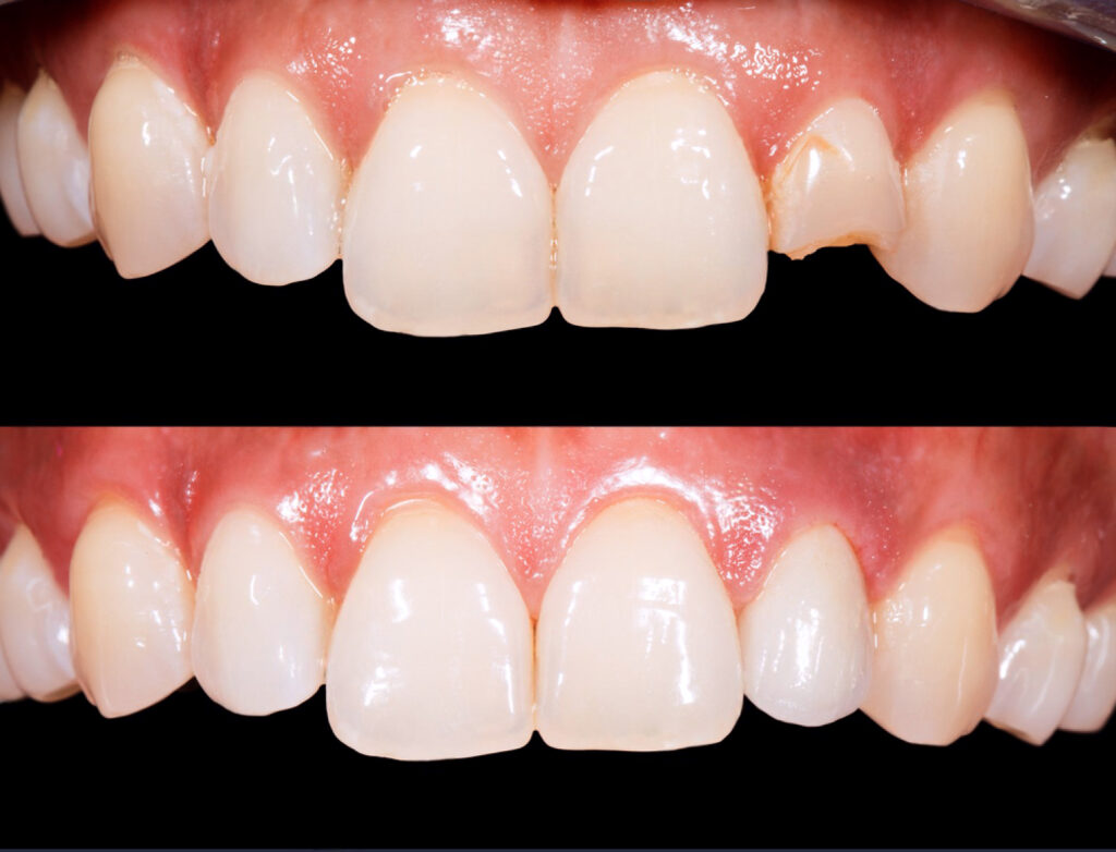 targovishte schupen kompozitna faseta