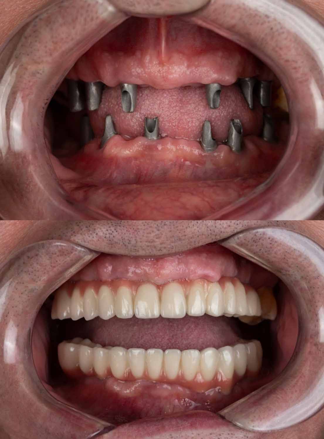 vsichki zybi s implanti targovishte